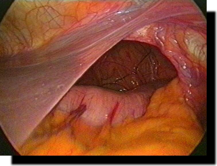 gro�e Hiatushernie + upside-down-stomach